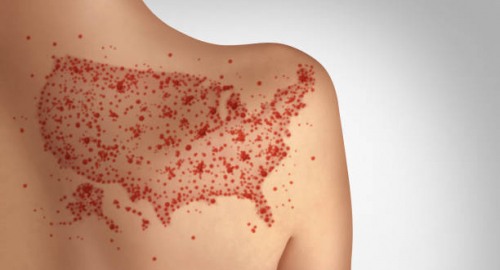Morbillo e Mondiali 2026, cresce l�attenzione sanitaria sulle grandi folle: vaccinazione e sorveglianza al centro della prevenzione